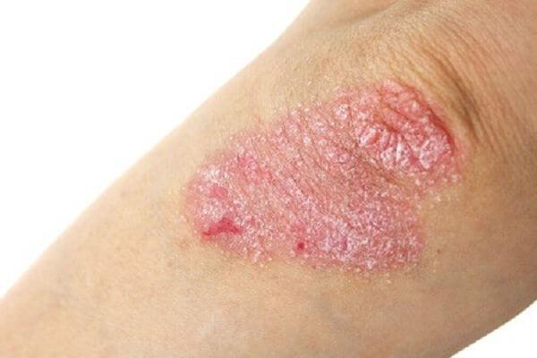 Phytotherapy a neurodermatitis